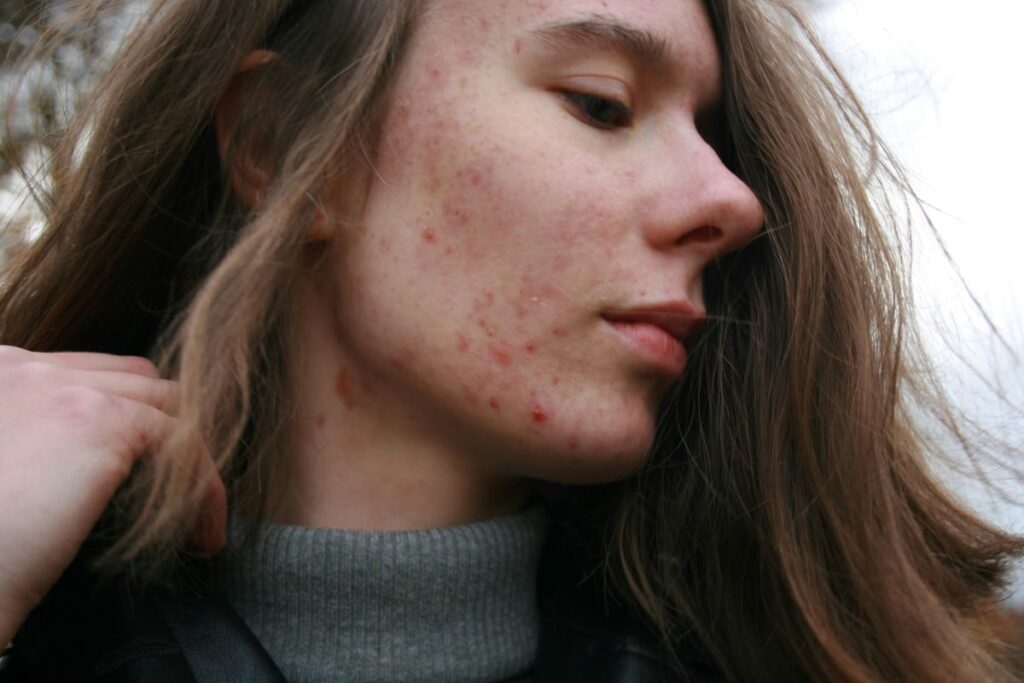 Girl has Acne