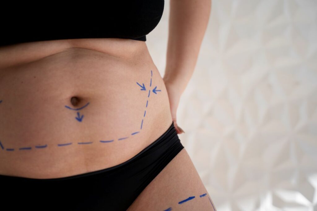 What Is a Tummy Tuck?