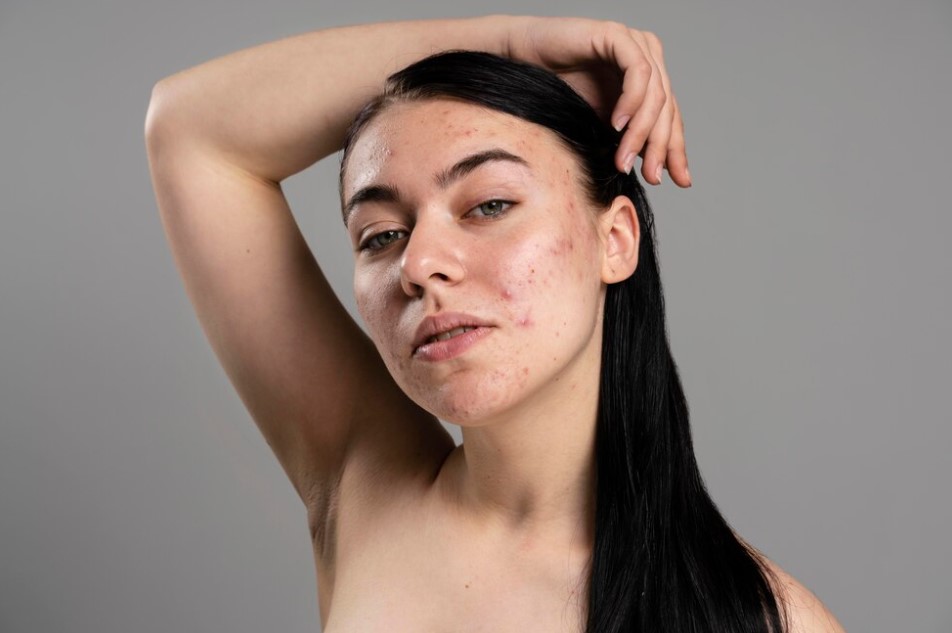 Identifying the Characteristics of Acne Marks