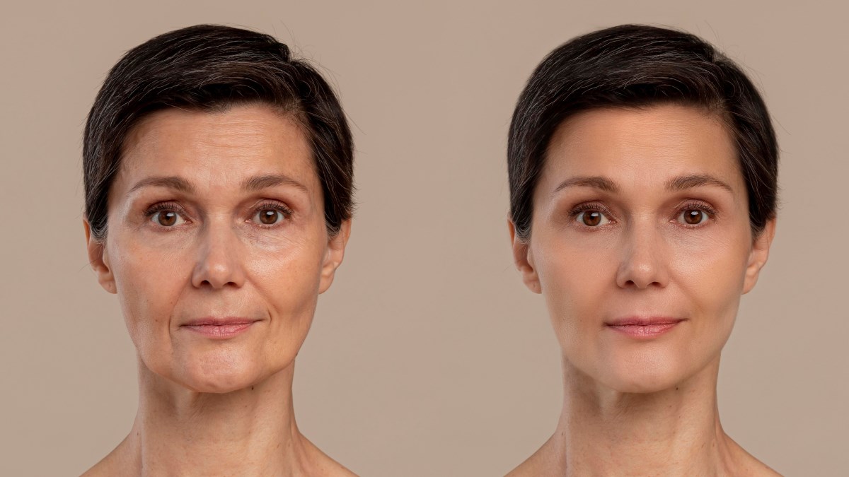 The Ultimate Botox Before and After Guide: Achieve Flawless Skin