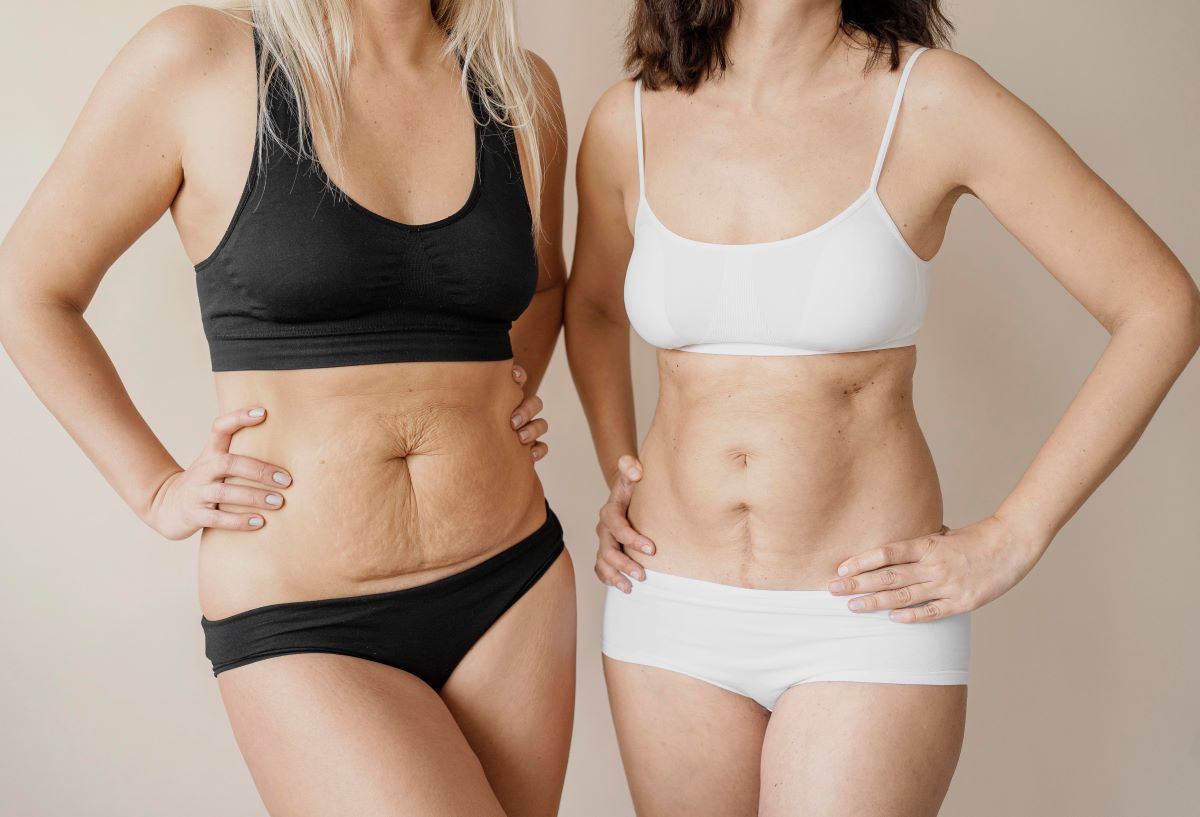 Discover the Power of Tummy Tuck Before and After Results